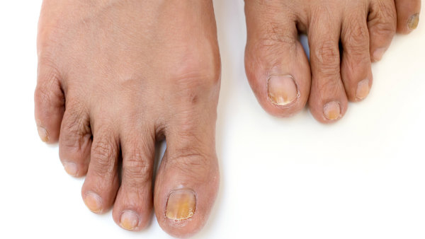 nail fungus