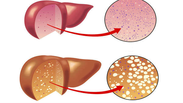 fatty liver symptoms fatty liver symptoms