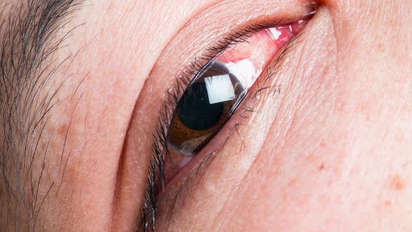 eye infection during monsoon