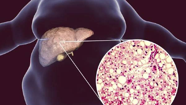 fatty liver disease symptoms
