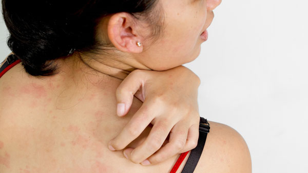skin rashes in malayalam