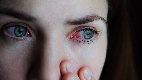 Pink eye monsoon infection