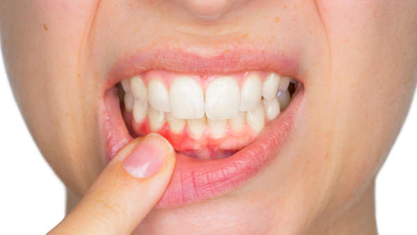 Gum colour and health issues