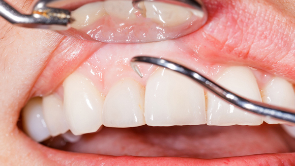 Gum color and health issues in malayalam