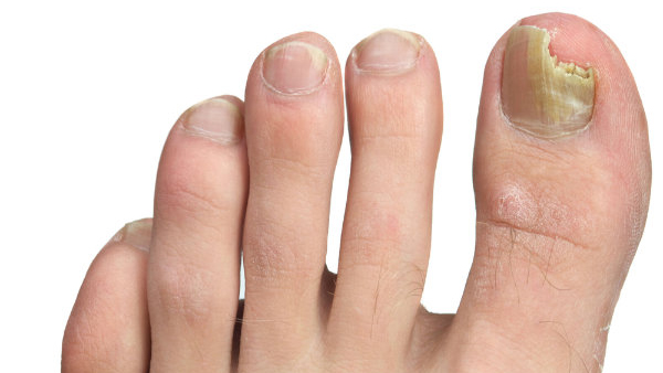foot nail fungus