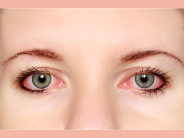 Conjunctivitis During Monsoon