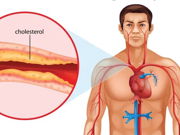 Cholesterol Level Increases In Body