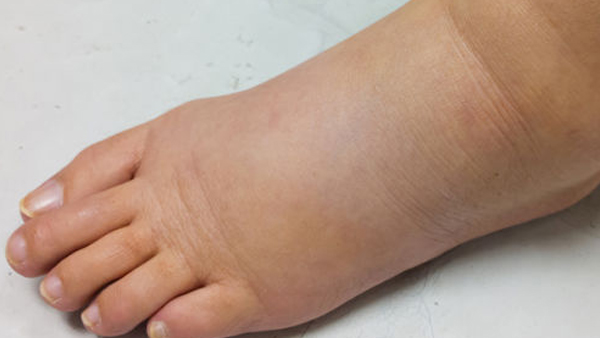 Naturally Reduce Uric Acid