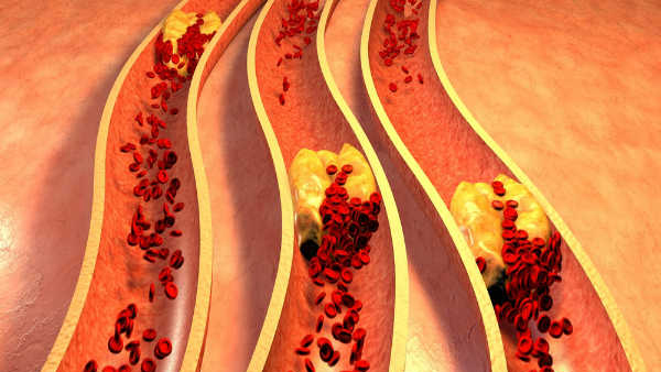 Symptoms Of High Cholesterol