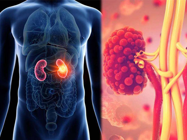 Signs And Symptoms Of Kidney Cancer