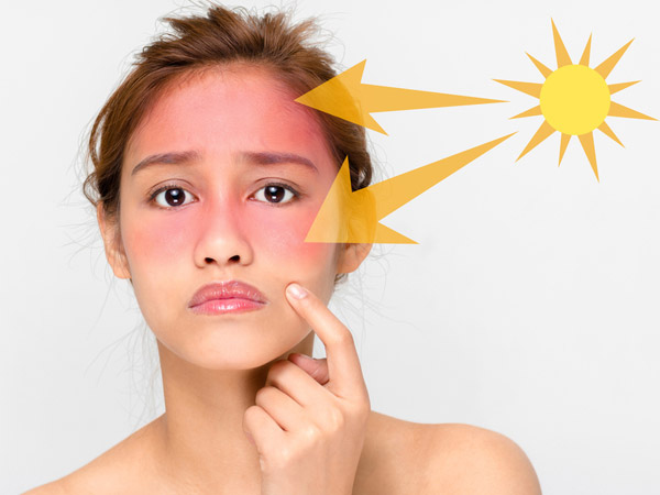 Tips To Protect Yourself From Sunburn