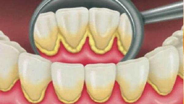 Healthy Teeth with Salt and Honey