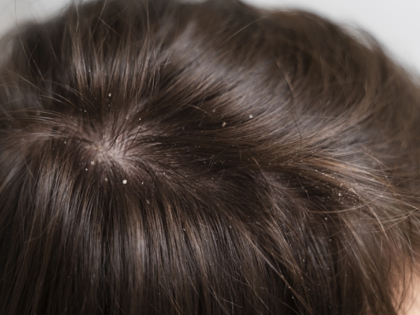 dandruff