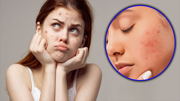 How To Get Rid Of Period Acne