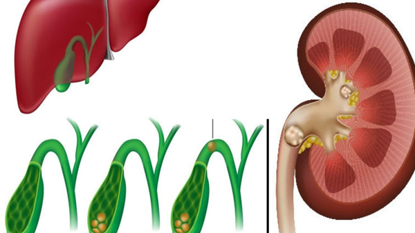 Removing Gallstones Removing Gallstones