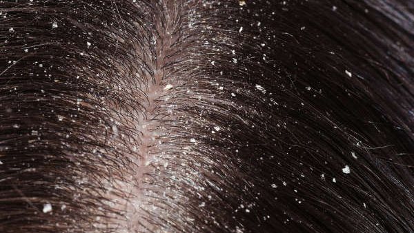 how to get rid of dandruff Dandruff diet