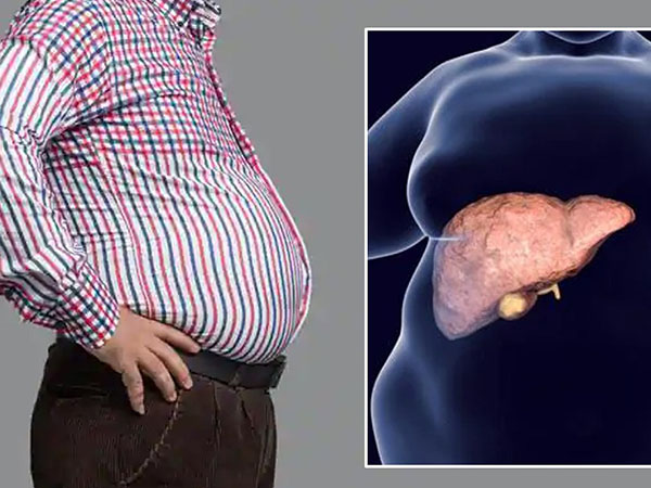 how to reduce fatty liver