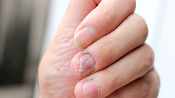 Home Remedies for Brittle Nails