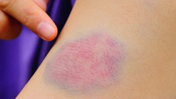 Diabetes and Skin Changes