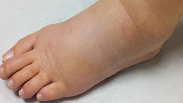 Unusual Symptoms of Prostate Cancer