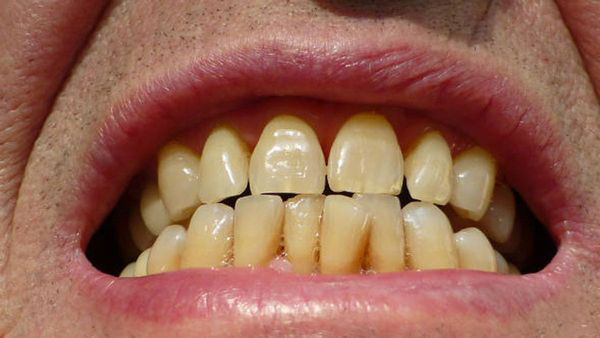 Easy DIY Remedies to Whiten Your Teeth Easy DIY Remedies to Whiten Your Teeth