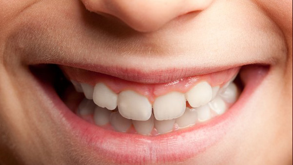 Gap Between Your Front Teeth
