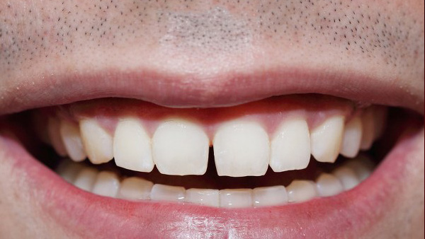 Gap Between Your Front Teeth