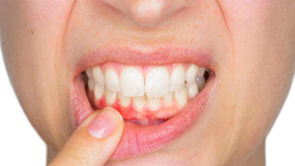 Vitamin K Deficiency