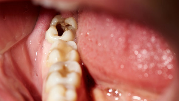 foods not healthy for teeth