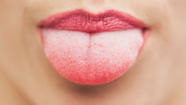 White Layer on Tongue