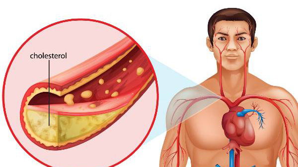 High Cholesterol Warning