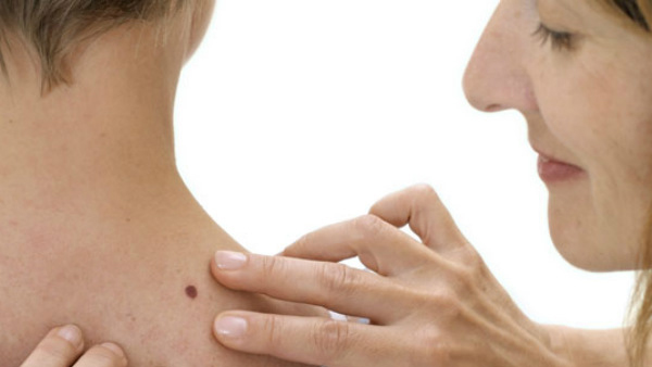 Moles on Neck and Shoulders