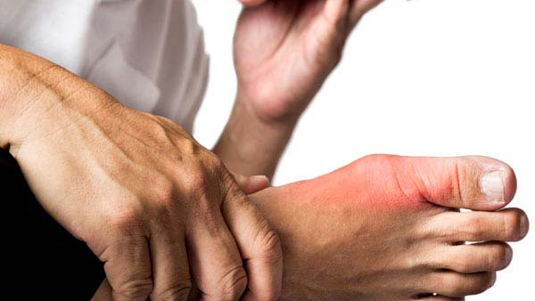 Warning Signs of High Uric Acid