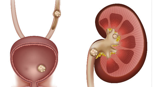 Kidney Stones in Winter