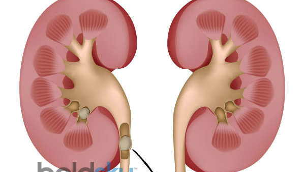 Kidney Stones in Winter