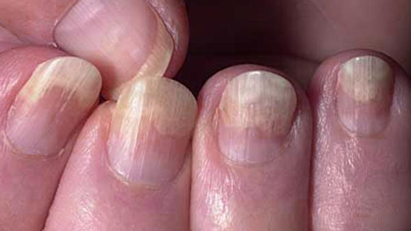 nail health