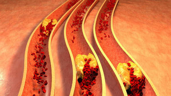 Symptoms of Blocked Blood Vessels Symptoms of Blocked Blood Vessels