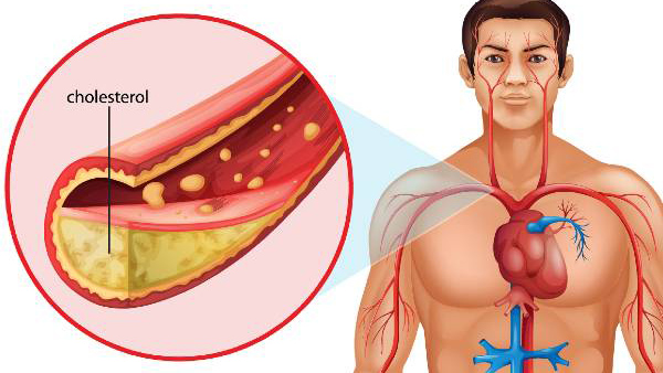 Bad Cholesterol in Youngsters Bad Cholesterol in Youngsters
