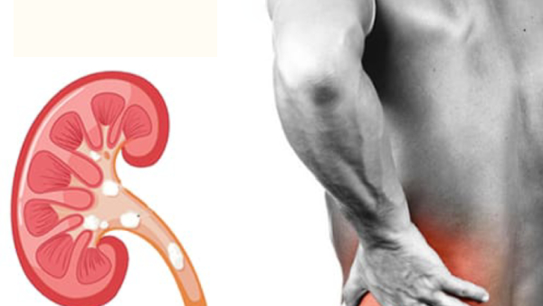 Causes of Kidney Stones Causes of Kidney Stones