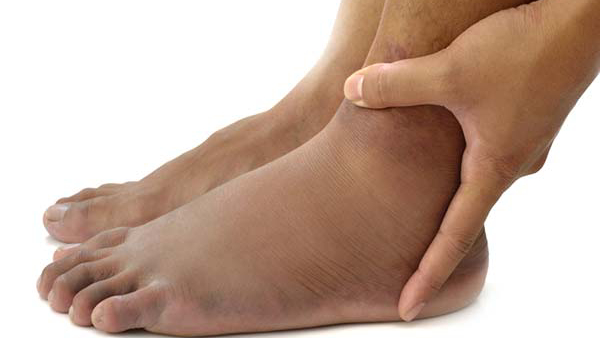 Leg Swelling and Numbness