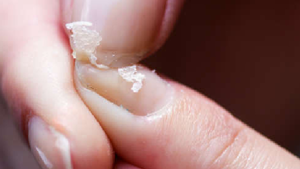 Vitamin D Deficiency