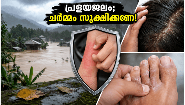 Flood Warning in Assam and Arunachal Pradesh 2026: Essential Skin and Foot Care Tips to Prevent Infections