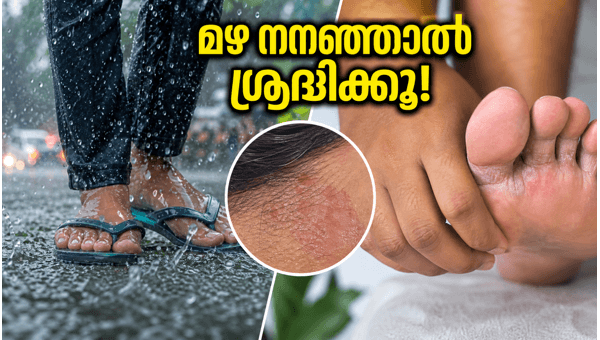 Monsoon Health Tips: Essential Hygiene Practices to Prevent Skin Infections and Fungal Issues