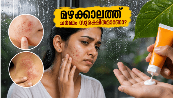 Monsoon Skincare Guide 2026: Protect Your Skin from Acne and Fungal Infections After First Rain