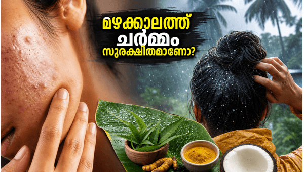 Monsoon Skincare Guide: How to Prevent Fungal Acne and Dandruff Effectively in 2026