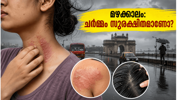 Mumbai Monsoon Skin and Hair Care: Essential Tips to Prevent Fungal Infections in 2026