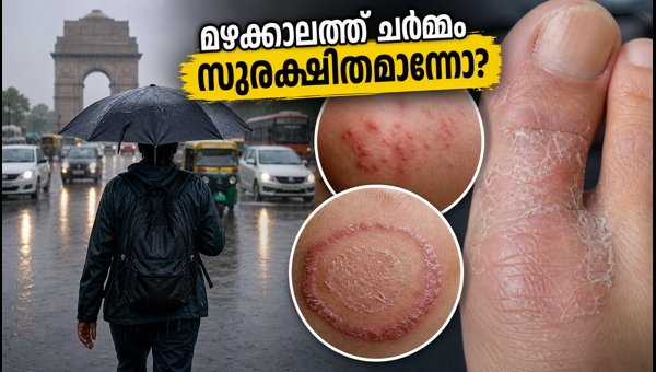 Monsoon Skin Care Tips 2026: How to Prevent Fungal Infections in Delhi-NCR Monsoon Skin Care Tips 2026: How to Prevent Fungal Infections in Delhi-NCR