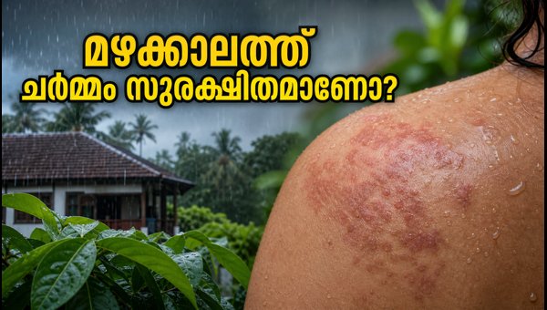 Monsoon Skincare and Scalp Care Tips 2026: How to Prevent Infections During Rainy Season Monsoon Skincare and Scalp Care Tips 2026: How to Prevent Infections During Rainy Season