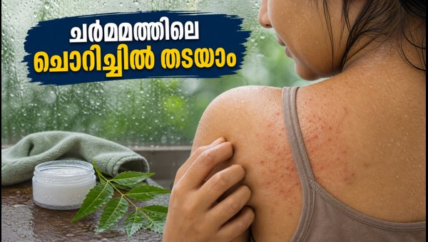 Monsoon Skin Care How to Prevent Sweat Rash and Fungal Acne in 2026 Monsoon Skin Care How to Prevent Sweat Rash and Fungal Acne in 2026