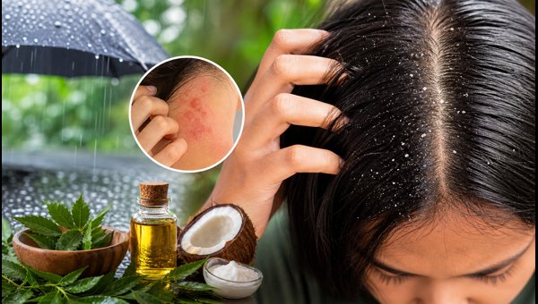 Monsoon Health Tips: How to Prevent Fungal Infections and Dandruff in 2026 Monsoon Health Tips: How to Prevent Fungal Infections and Dandruff in 2026